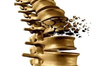 osteoporosi sarcopenia e obesità da questi 3 fattori ha origine l'obesità osteosarcopenica